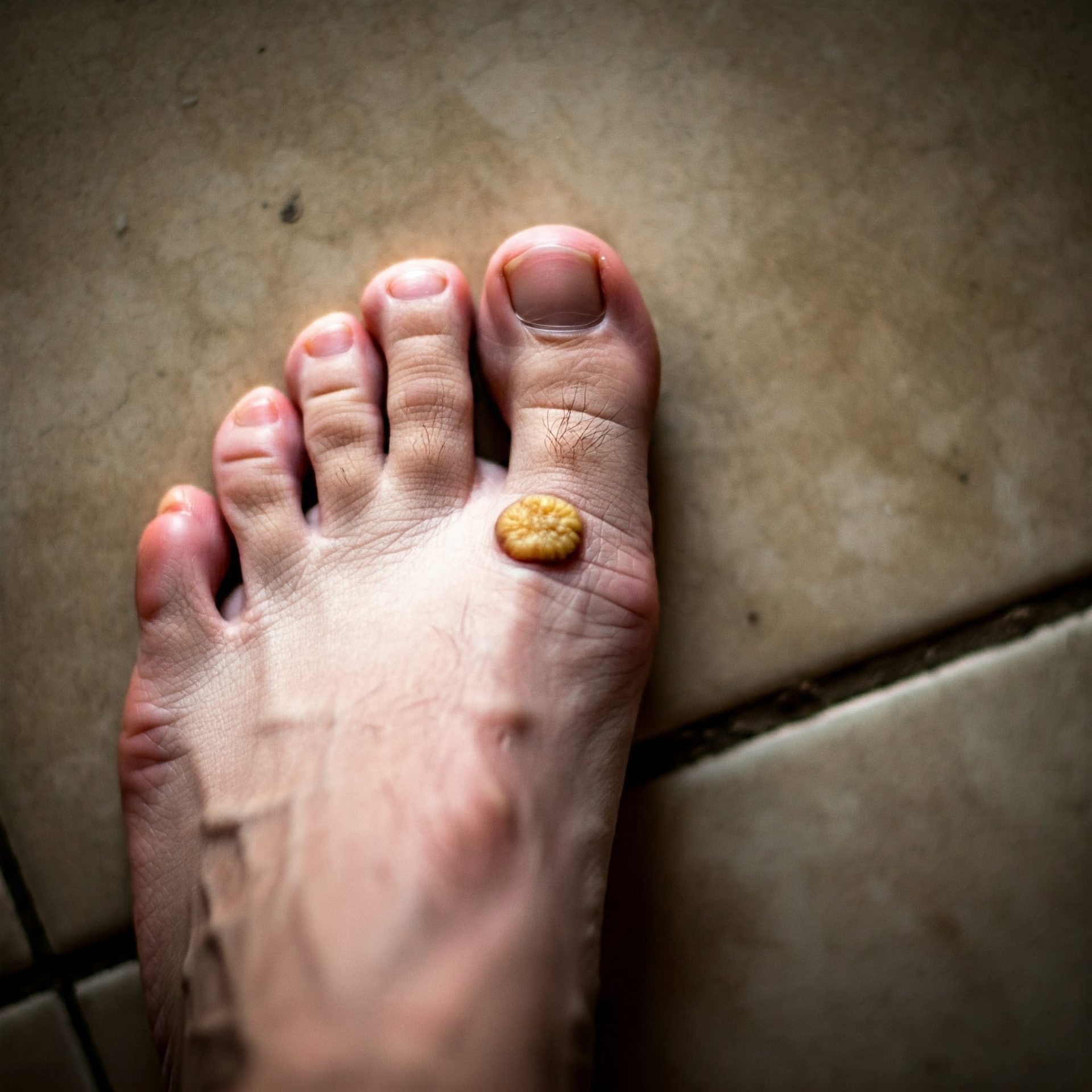 Tile Floors Cause Warts